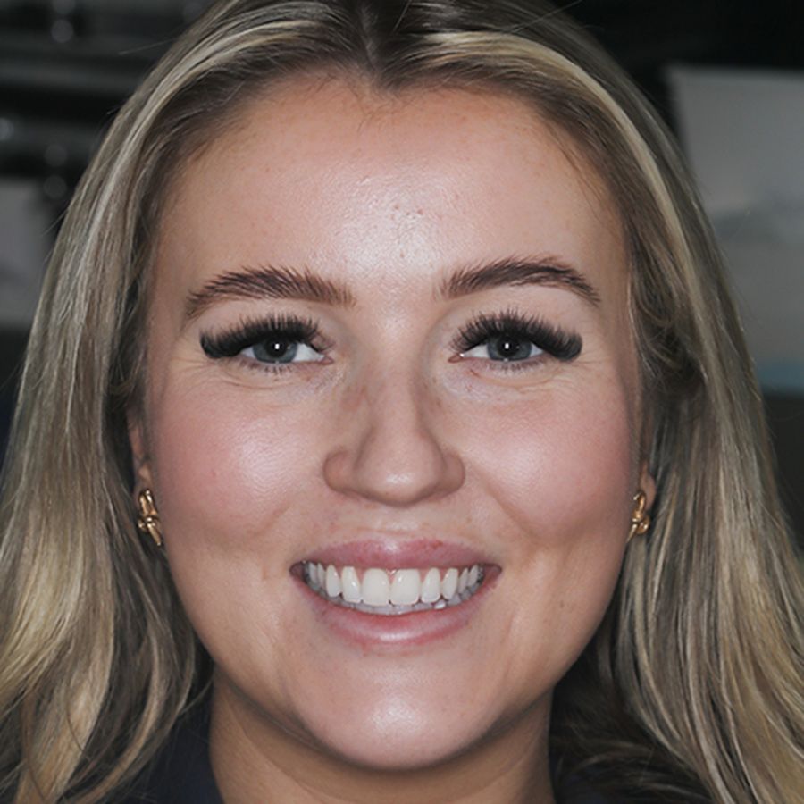 Orla - composite bonding - before - Carmen - 3dental